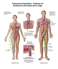 Pulmonary Embolism Pathway Fine Art Print - Embolus to Heart & Lungs