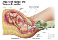 Medical Illustration of Fetal Delivery via Vacuum Extraction Print