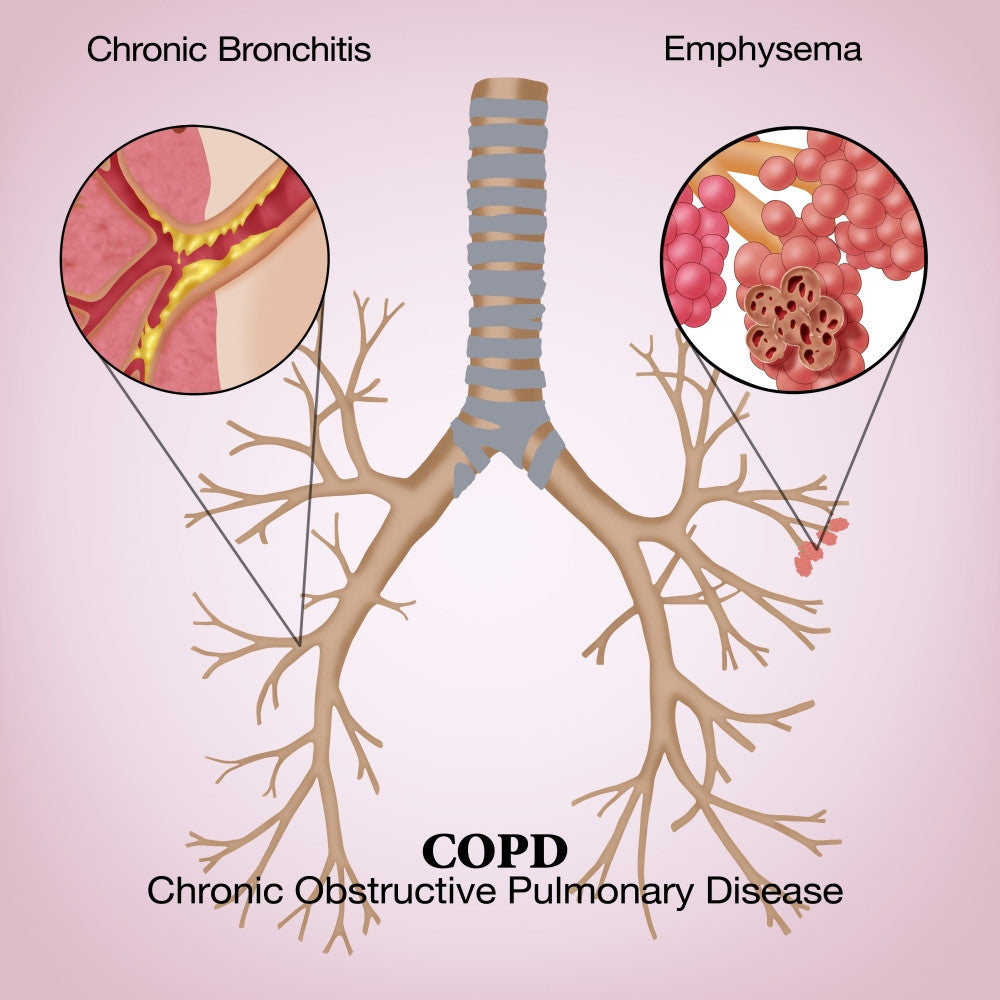 Chronic Obstructive Pulmonary Disease Fine Art Print by Monica Schroeder