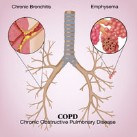Chronic Obstructive Pulmonary Disease Fine Art Print by Monica Schroeder