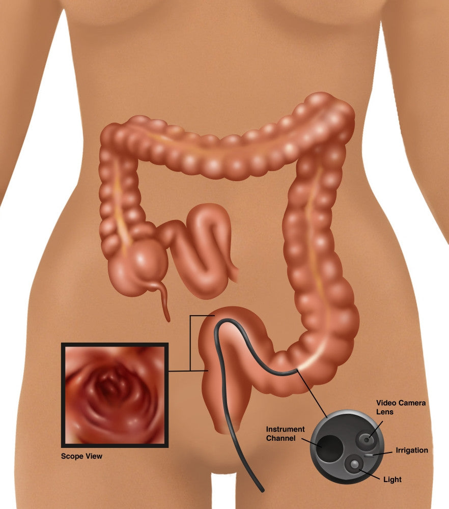 Colonoscopy Fine Art Print by Gwen Shockey | Science Source