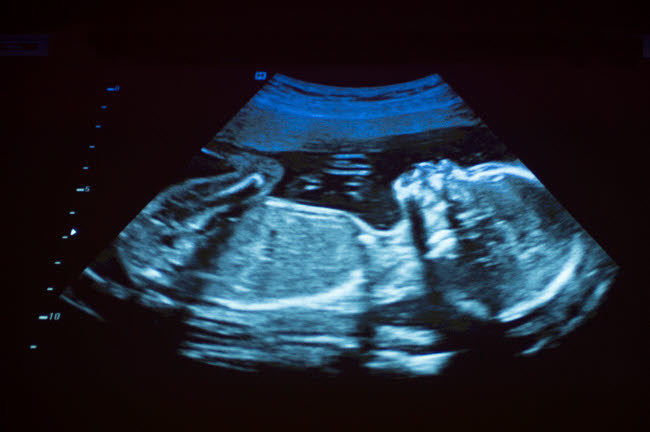 Ultrasound of a 20 Week Pregnancy Fine Art Print by VWPics