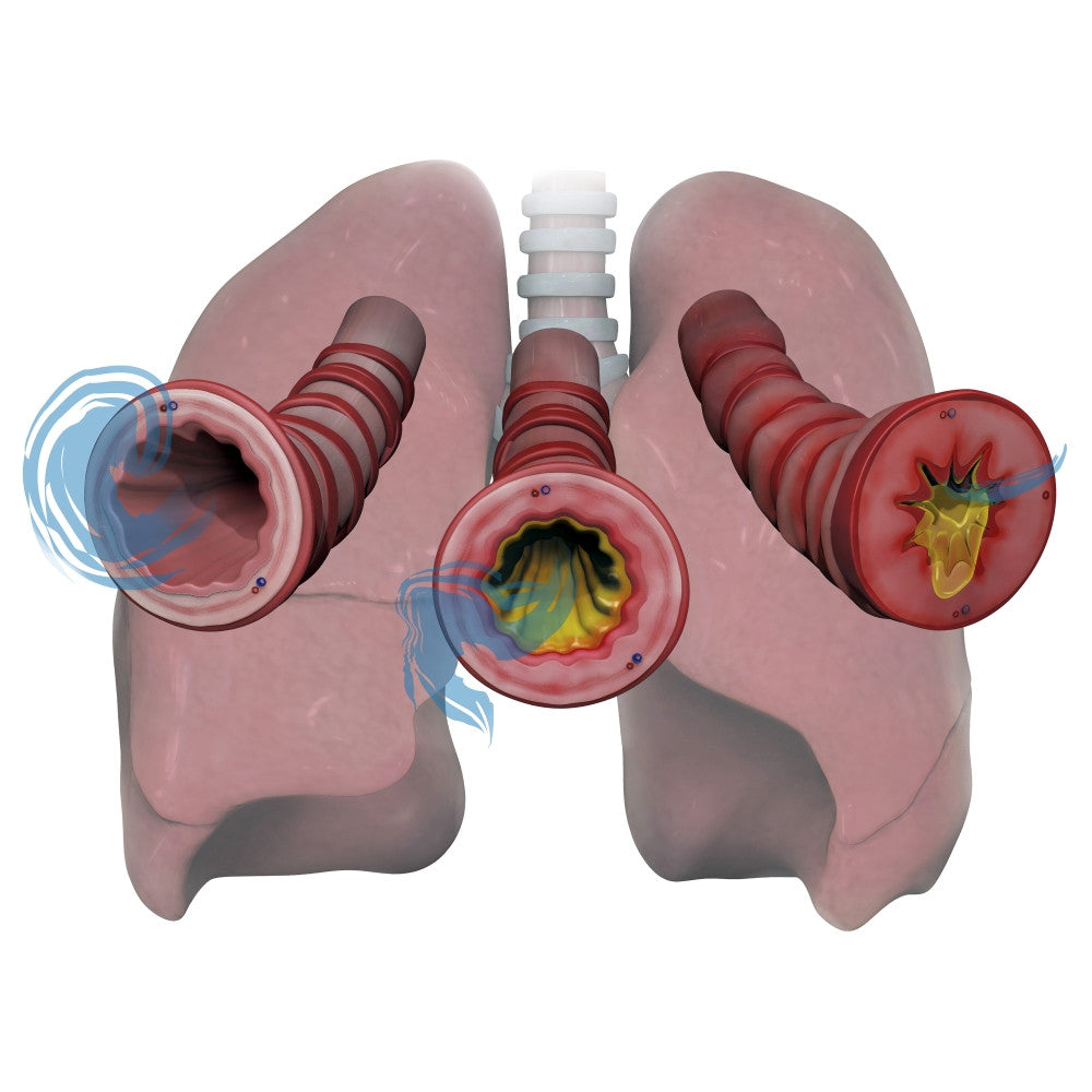 Asthma Stages of Inflammation and Mucus Fine Art Print by Photon Illustration