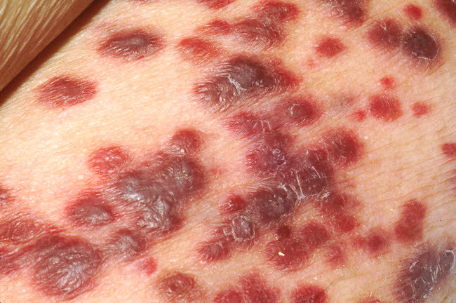 Kaposi's Sarcoma Fine Art Print - AIDS Patient Skin Study by NIH