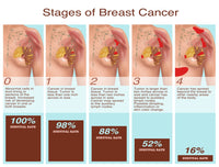 Breast Cancer Stages Illustration Fine Art Print by Gwen Shockey