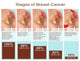 Breast Cancer Stages Illustration Fine Art Print by Gwen Shockey