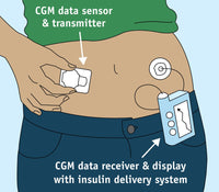 Continuous Glucose Monitor Fine Art Print by Science Source