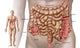 Diverticulitis Illustration Fine Art Print - Descending Colon Anatomy