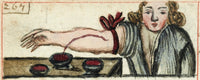 Bloodletting Illustration Fine Art Print by Science Source
