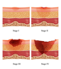 Bed Sores Fine Art Print by Monica Schroeder - Science Source