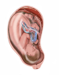 Pregnancy Complication: Placental Abruption Fine Art Print by TriFocal Communications