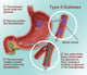 Type 2 Diabetes Educational Poster Print by Science Source