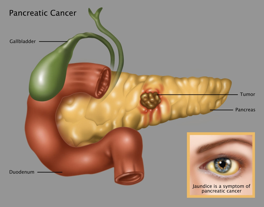 Pancreatic Cancer Illustration Fine Art Print by Gwen Shockey