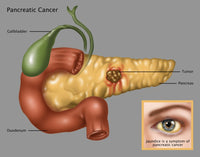 Pancreatic Cancer Illustration Fine Art Print by Gwen Shockey
