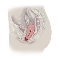 Sagittal Section of Pelvis with Prolapsed Uterus Fine Art Print by TriFocal Communications