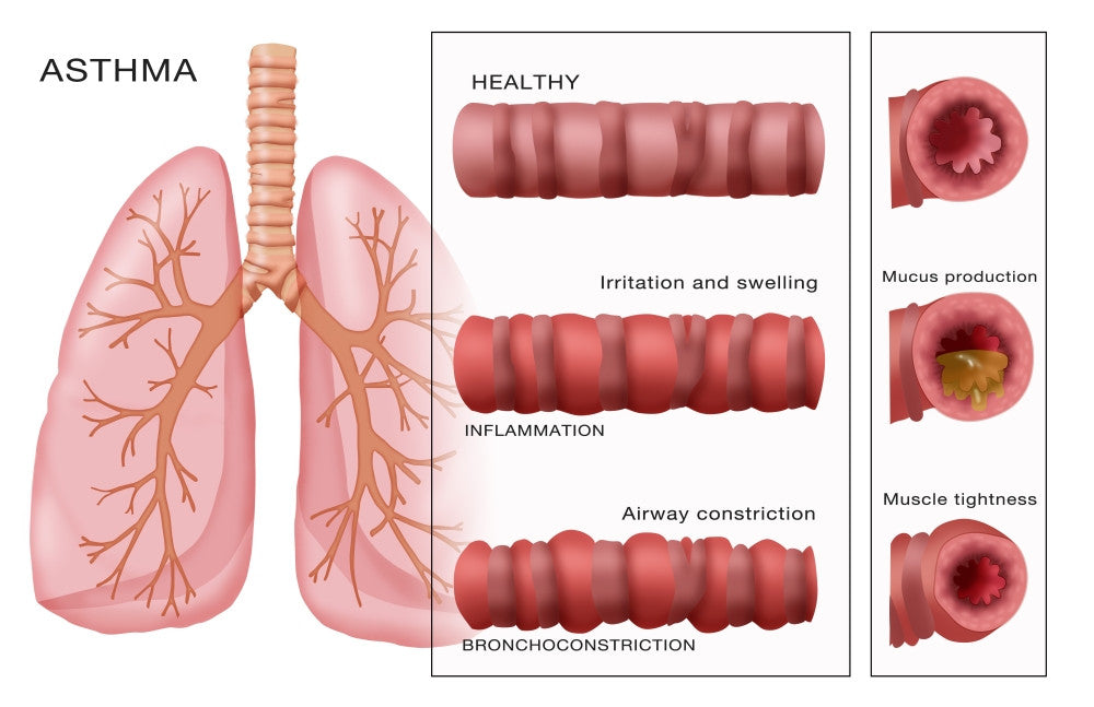 Bronchoconstriction Asthma Fine Art Print by Science Source