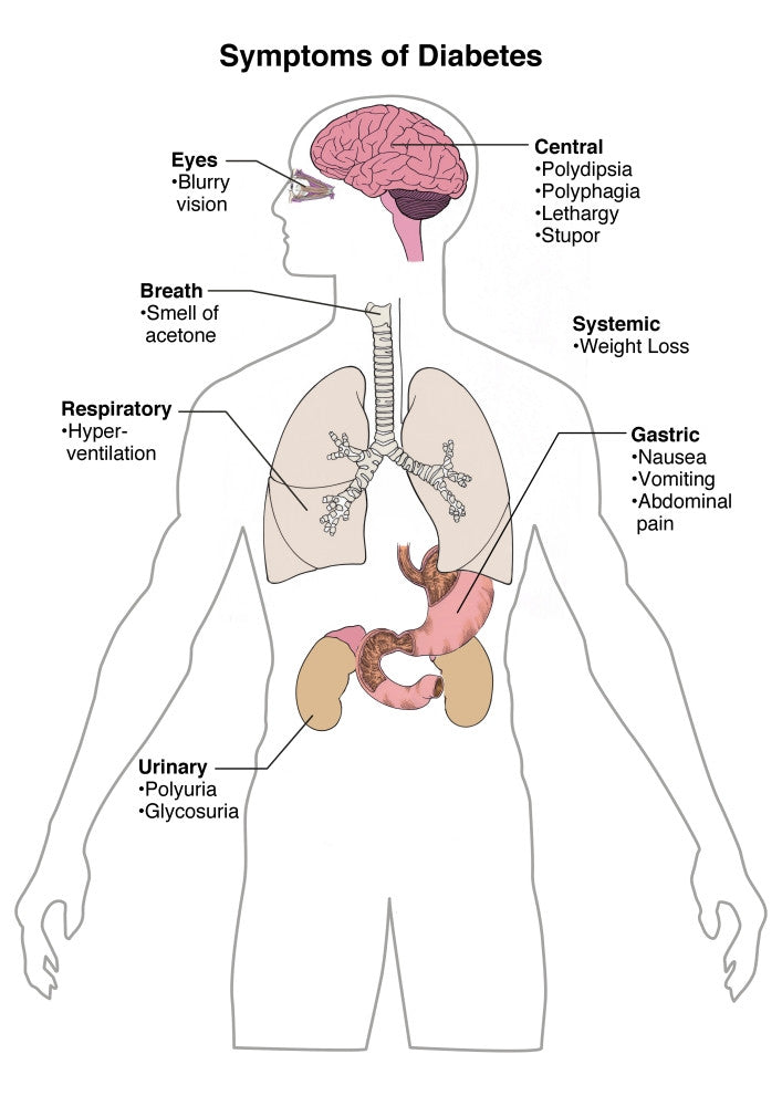 Symptoms of Diabetes Educational Poster Print by Science Source