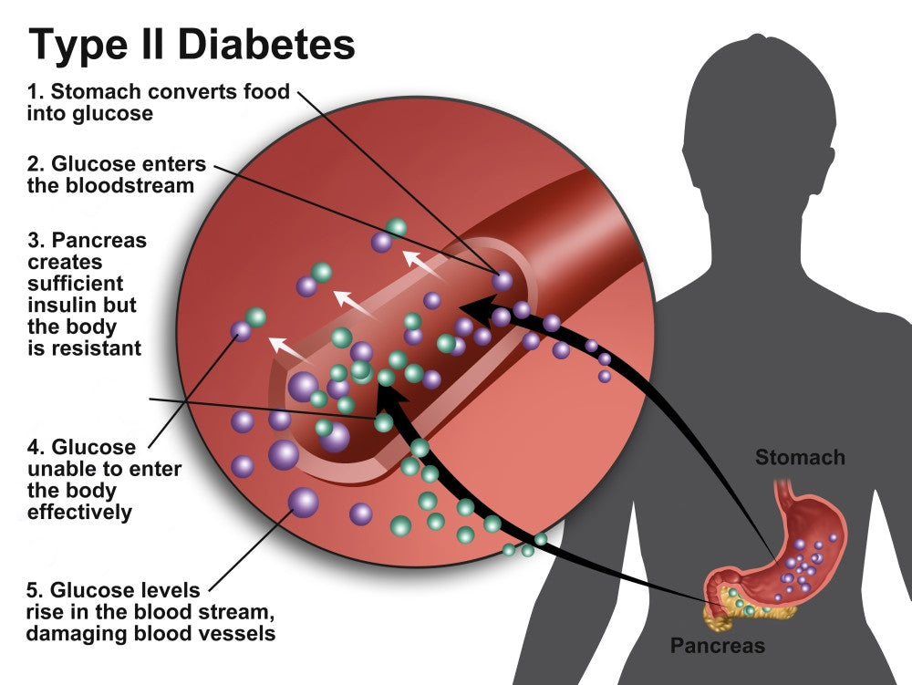 Type 2 Diabetes Educational Poster Print by Gwen Shockey