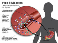 Type 2 Diabetes Educational Poster Print by Gwen Shockey