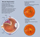 Retina with Macular Degeneration Fine Art Print by TriFocal Communications