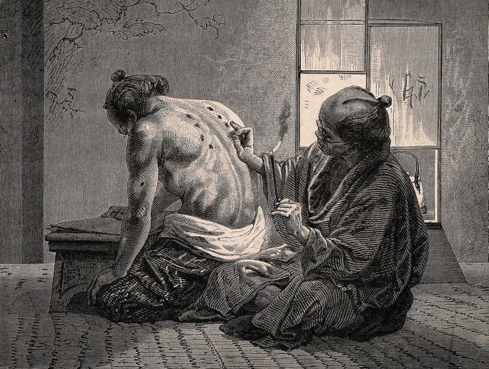 Japanese Physician Applying Moxa Fine Art Print, c.1870s by Science Source