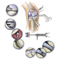 Detail of Human Knee Arthroscopic Surgery Fine Art Print by TriFocal Communications