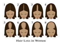 Hair Loss Educational Poster Print by Science Source