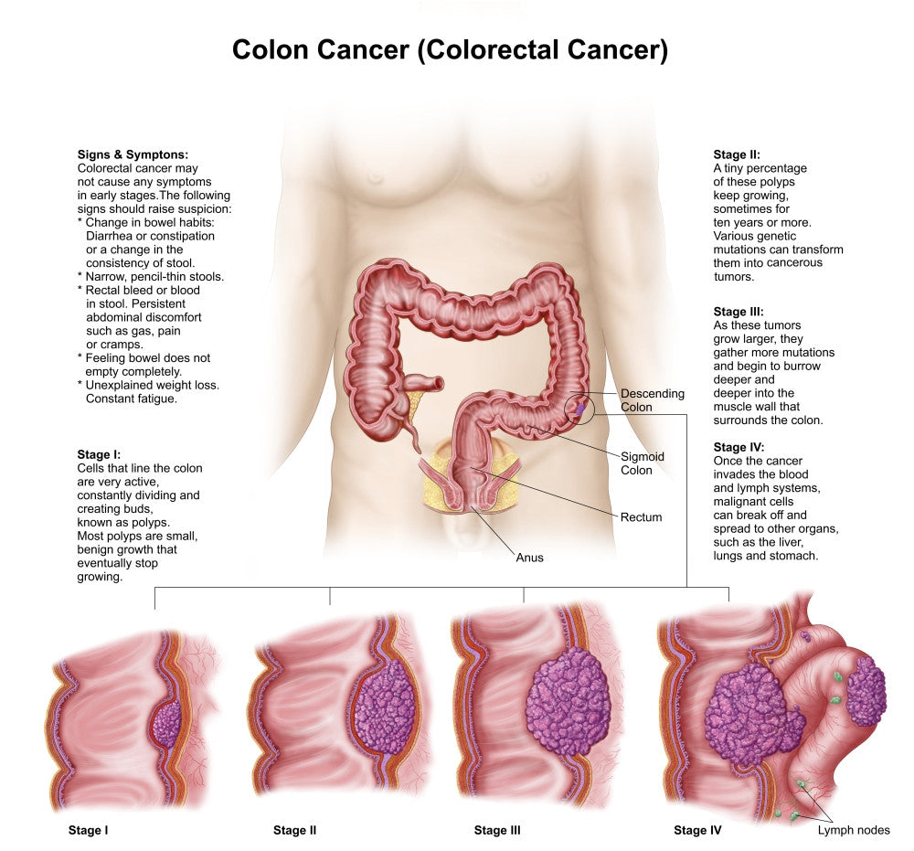 Medical Illustration of Colon Cancer Stages Fine Art Print