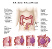 Medical Illustration of Colon Cancer Stages Fine Art Print