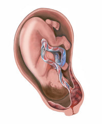 Pregnancy Complication: Placenta Previa Fine Art Print by TriFocal Communications