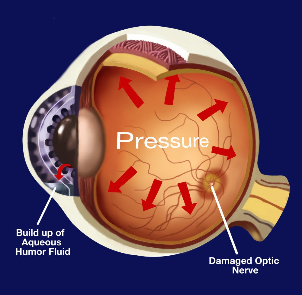 Glaucoma Fine Art Print by Spencer Sutton | Science Source