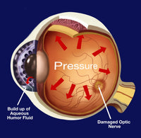 Glaucoma Fine Art Print by Spencer Sutton | Science Source