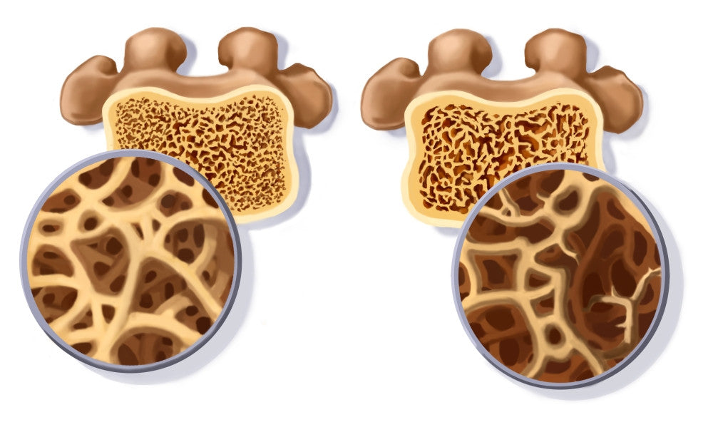 Osteoporosis Educational Poster Print by Spencer Sutton