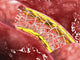 Microscopic Artery Cross-Section Fine Art Print - Blood Flow & Stent Deployment