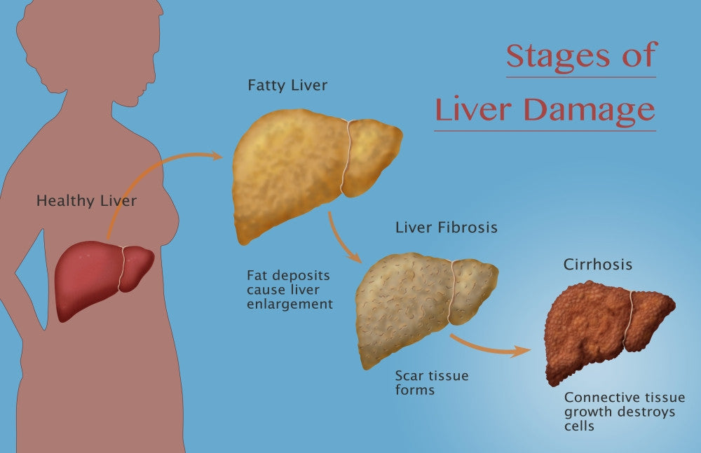 Stages of Liver Damage Fine Art Print by Monica Schroeder