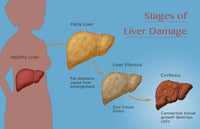 Stages of Liver Damage Fine Art Print by Monica Schroeder