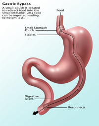 Gastric Bypass Surgery Fine Art Print by Gwen Shockey
