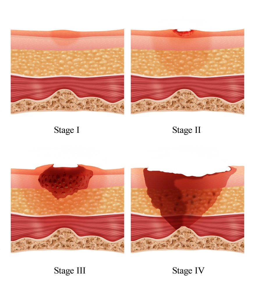 Bed Sores Fine Art Print by Monica Schroeder - Science Source