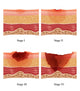 Bed Sores Fine Art Print by Monica Schroeder - Science Source