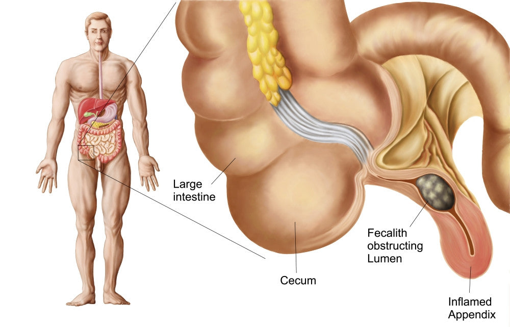 Medical Illustration of an Appendix with Appendicitis Fine Art Print